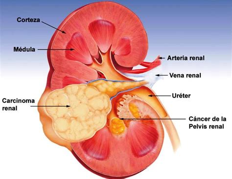 Cáncer Renal Dr Enrique Jiménez Valle Urólogo