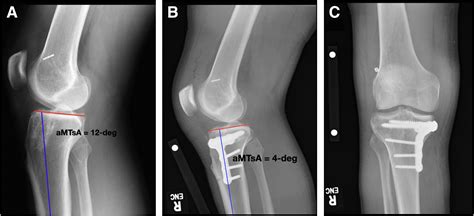 Anterior Closing Wedge High Tibial Slope Correcting Osteotomy Using