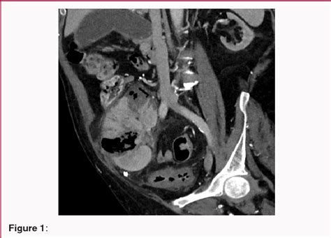 Figure From Successful Conservative Treatment Of Extensive