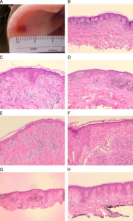 Compound Nevus With Mild Atypia