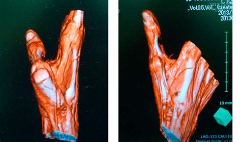 Figure 2 From Reconstruction Of Extensor Tendon Dislocation Due To