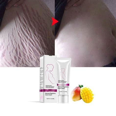 Drfeify Scar Stretch Remover Cicatrices Remover Cream Mango Remove