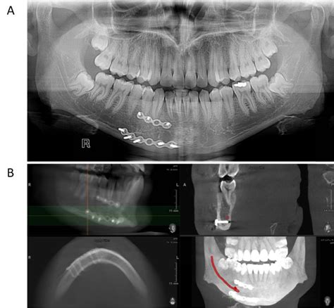 Is Dental Panoramic Radiography Reliable To Assess Position Of