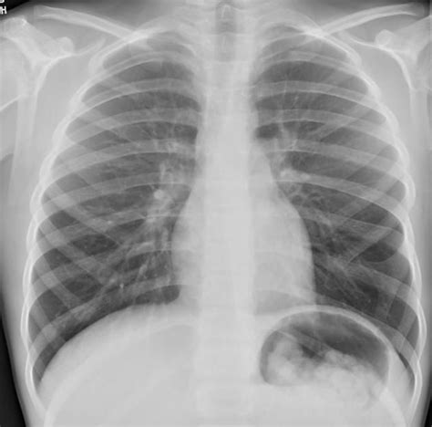 Log In Radiology Radiography Ribs