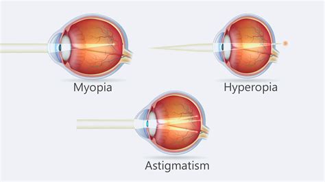 Myopia Hyperopia Astigmatism