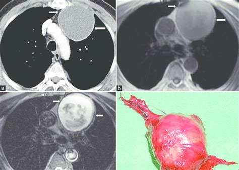 Thymus Cyst