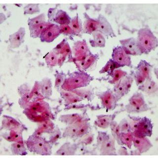 Pap smear showing LSIL. Pap staining in a patient with LSIL showing ...