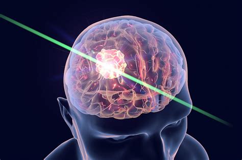 Brain Cancer Treatment With Laser By Kateryna Kon Science Photo Library