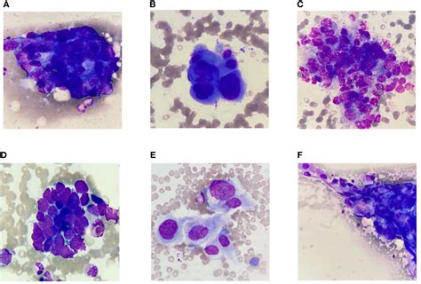 Frontiers Detection Of Metastatic Tumor Cells In The Bone Marrow