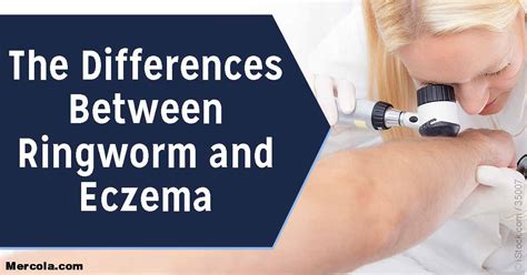 The Differences Between Ringworm and Eczema