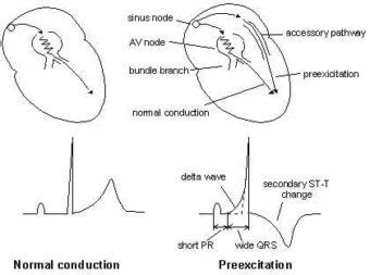 Pre-excitation syndromes • LITFL • ECG Library Diagnosis