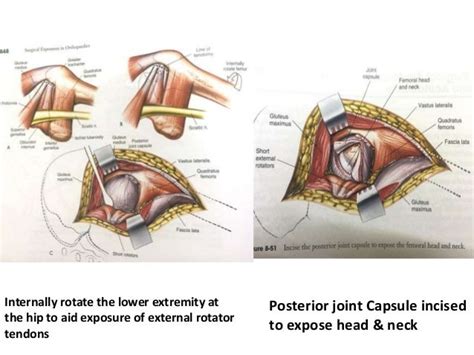 Hemiarthroplasty Of Hip Joint