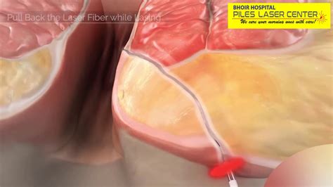 Fistula Laser Treatment Youtube