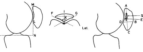 Table From Radiologic Evaluation Of Chondromalacia Patellae