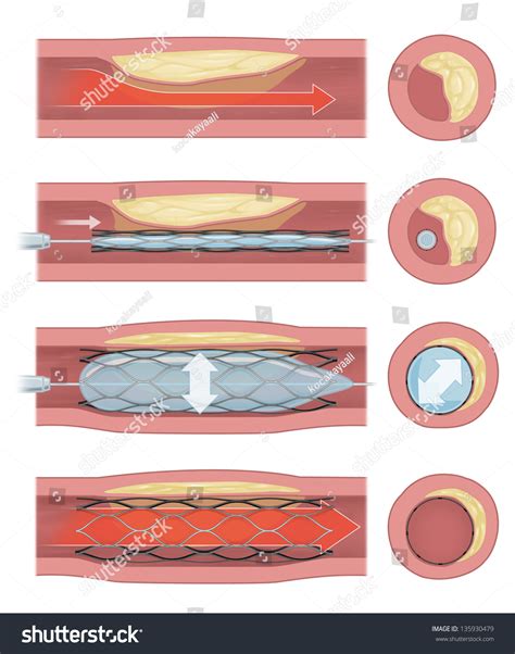 16 Coronary Angio Images, Stock Photos & Vectors | Shutterstock