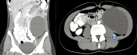 Figure 1 CT Primary Retroperitoneal Mucinous Cystadenoma Nodule