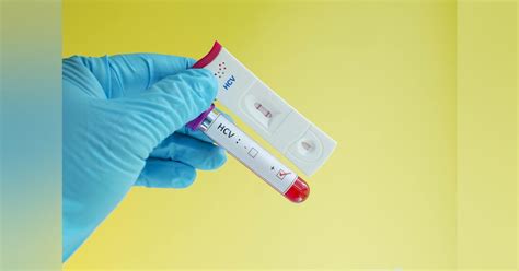 Who Prequalifies The First Self Test For Hepatitis C Virus Medical Laboratory Observer