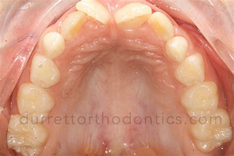 Before And After Photos Durrett Orthodontics