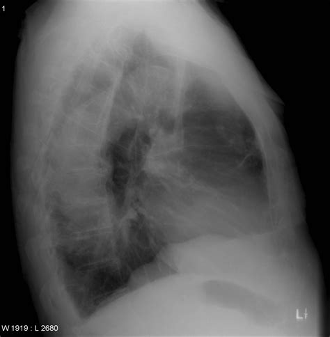 Ectatic thoracic aorta | Image | Radiopaedia.org