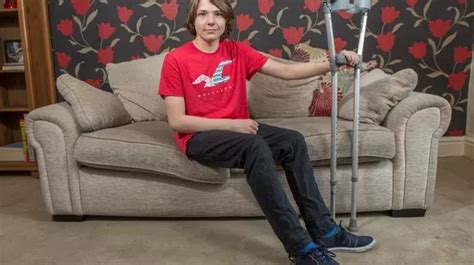 Brave Teen Throws Leg Leaving Party As He Prepares To Have Arthritic Limb Amputated After 20