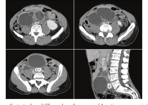 PDF Benign Multicystic Peritoneal Mesothelioma In A Male Patient With