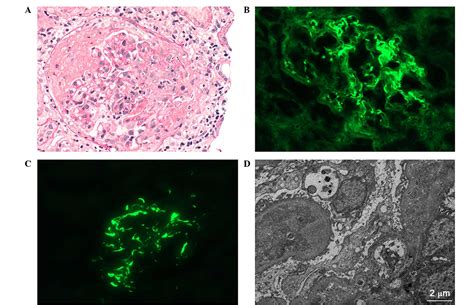 Anti Glomerular Basement Membrane Nephritis Incidence Openbasement