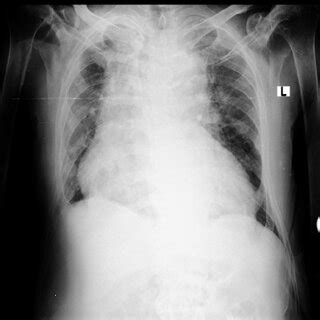 Samples of COVID-19 Chest X-Ray images with positioning errors | Download Scientific Diagram