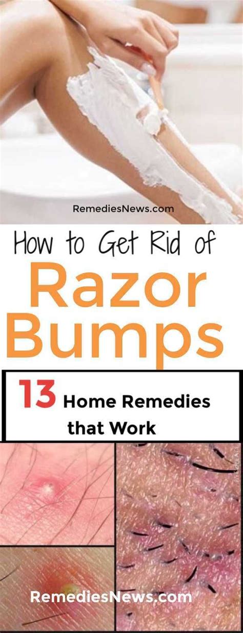 Easy Quick Way To Get Rid Of Razor Bumps