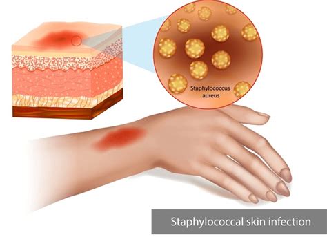 1179 En La Categoría Cellulitis Infection De Fotos E Imágenes De Stock Libres De Regalías