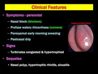 Intrinsic Rhinitis And Rhinitis Medicamentosa Ppt