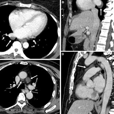 Pericardial Recesses Contrast Enhanced Axial A And Sagittal B Ct