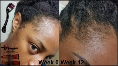 Regrow Edges Challenge Derma Roller Virgin Hair Fertilizer Week