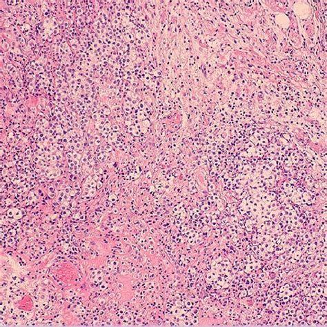 Pleural pathology: malignant mesothelioma demonstrated. | Download ...