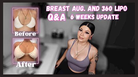 Qanda Breast Augmentation 360 Lipo Youtube