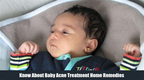 Know About Baby Acne Treatment Home Remedies - World Informs