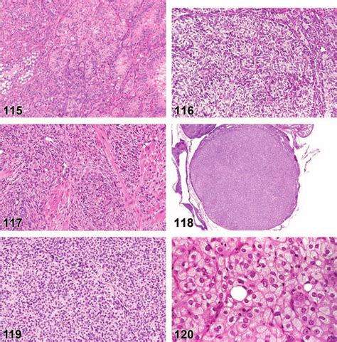 Sex Cord Stromal Tumor Mixed Benign Ovary Rat Figure 116 Thecoma Download Scientific