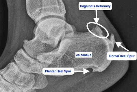 Haglund Deformity Understanding Causes Symptoms And Treatments