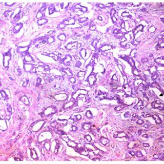 Infiltrating Duct Carcinoma Idc Grade Ii Showing Tubular Formation