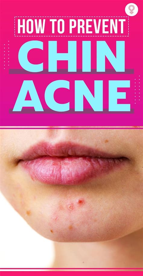 Chin Acne Pimples Causes Treatment And Skin Care Tips Artofit