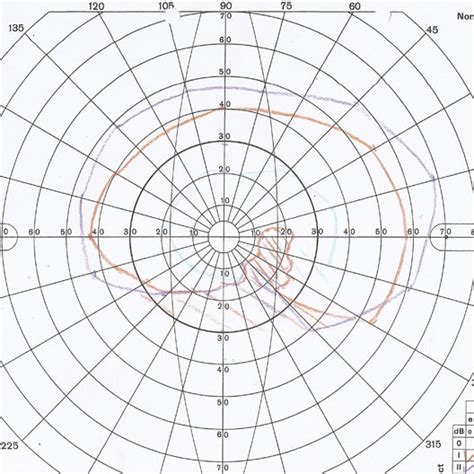 Goldmann visual field test demonstrating an inferior altitudinal visual ...