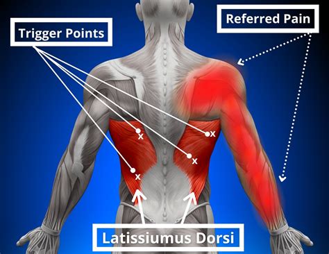 Tight Lats Symptoms Steps To Cure Latissimus Dorsi Pain Trigger Points