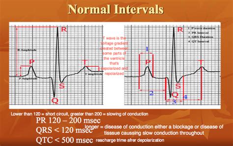 Bod Quiz 1 Arrhythmias Flashcards Quizlet