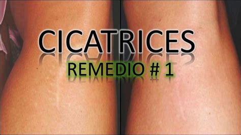 CICATRICES Como Quitar Las Cicatrices Remedios Caseros YouTube