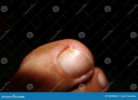 Ingrown Toenail On Foot Doctor Examines Thumb Royalty Free Stock