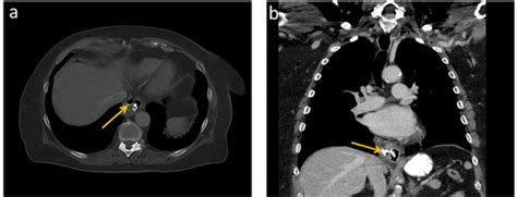 Full Article Non Surgical Treatment Of Esophageal Perforation After