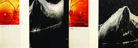 Macular OCT showing bilateral macular oedema. | Download Scientific Diagram