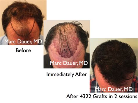 High Density Hair Transplant Marc Dauer Md Hair Transplant Doctor Los Angeles