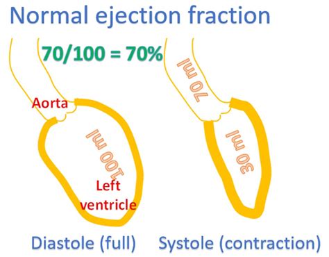 What is heart failure with preserved ejection fraction? - All About Heart And Blood Vessels