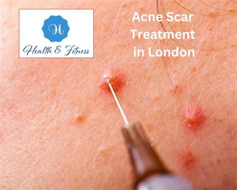 A Comprehensive Guide To Effective Acne Scar Treatment In London