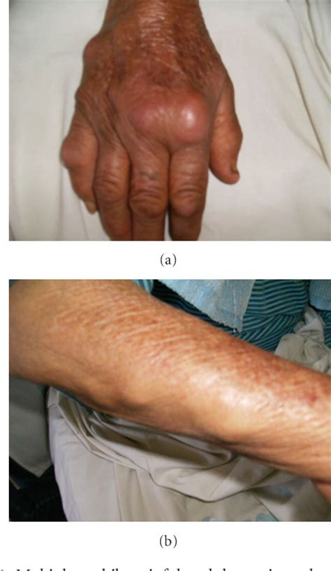 Figure 1 From A Seropositive Nodular Rheumatoid Polyarthritis Without